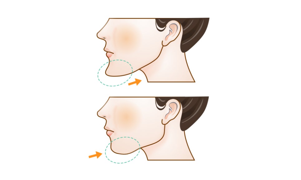 Side Effects After Facial Contouring (Square Jaw, Chin Tip) Surgery: Double Chin and Salivary Gland Enlargement image 2