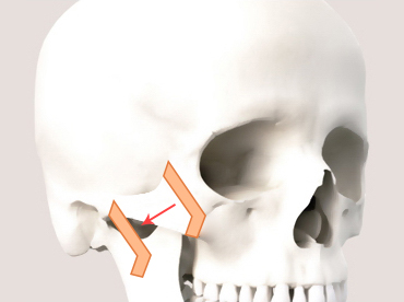 Why Is Male Cheekbone Reduction Different from Female Cheekbone Reduction? image 6