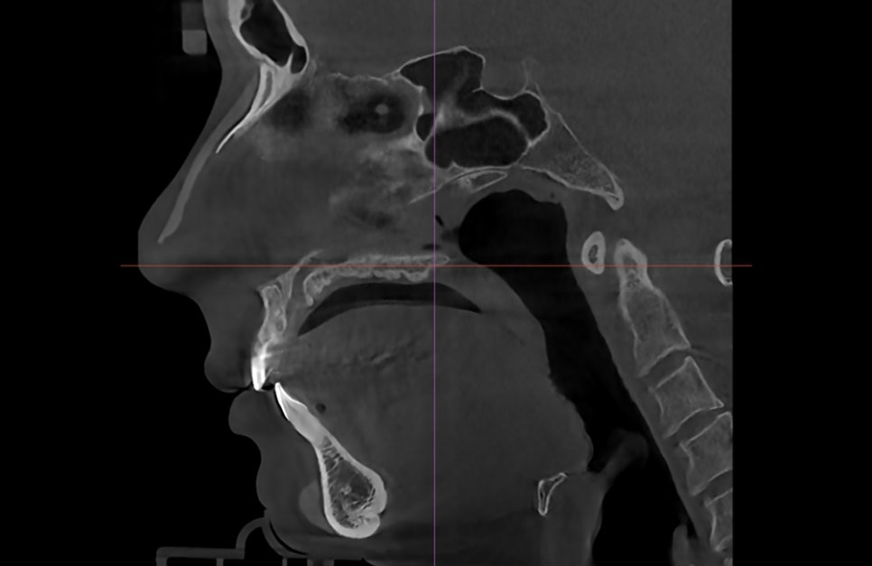 What Surgery Is Best for Correcting a Short Chin or Recessed Chin? The Limits of Chin Surgery and the Actual Results image 7