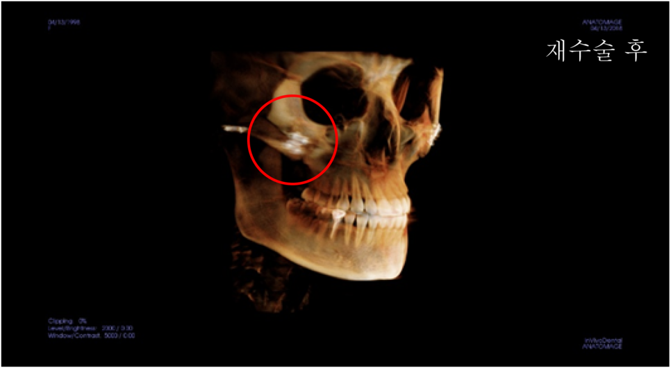 A Complete Summary of 6 Complications After Cheekbone Surgery: Sinusitis, Recurrence, Hollow Cheeks, and Sagging Cheeks image 5