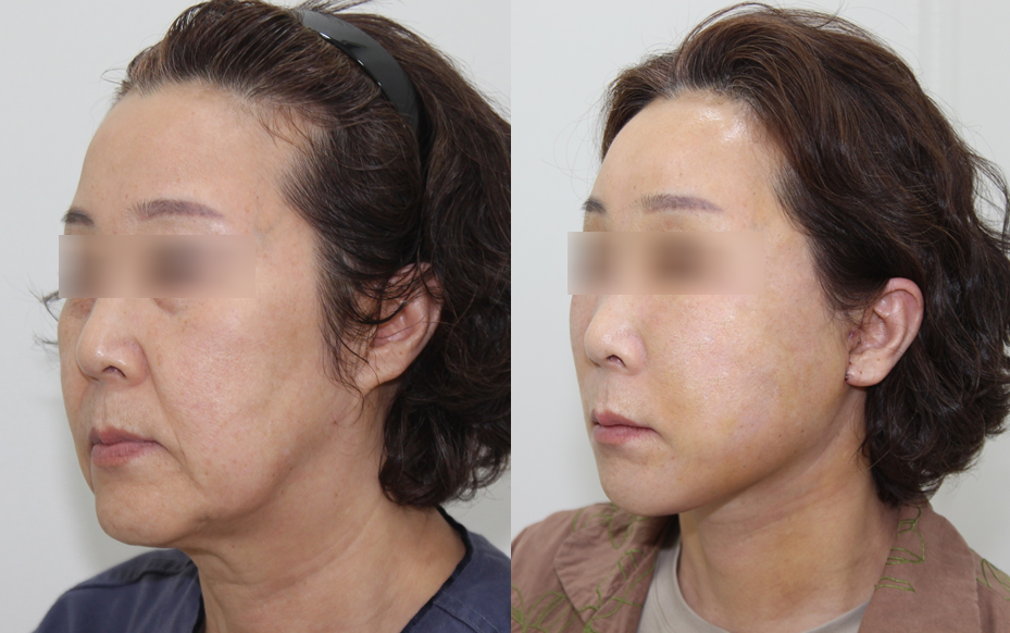 When Are Facial Contouring Surgery and Facelift Surgery Needed Together? image 9
