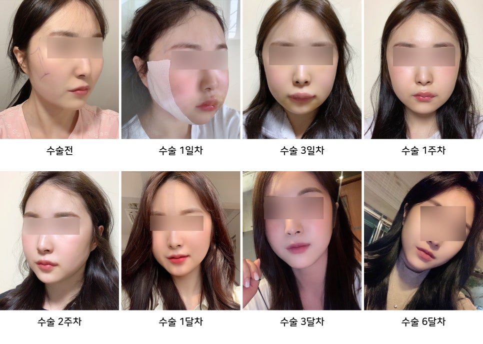 안면윤곽 수술 후 붓기와 회복기간, 케이스 바이 케이스 관련 이미지 2