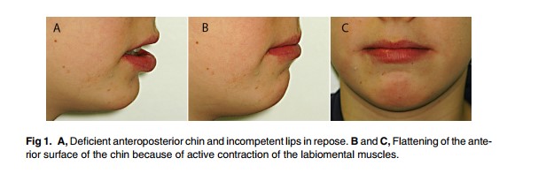 [Paper Review] The Relationship Between Forward Movement of the Chin Bone and Soft Tissue Movement: After Chin Advancement Surgery, How Will My Face Actually Change? image 3