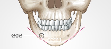 What Is Chin Surgery? image 5