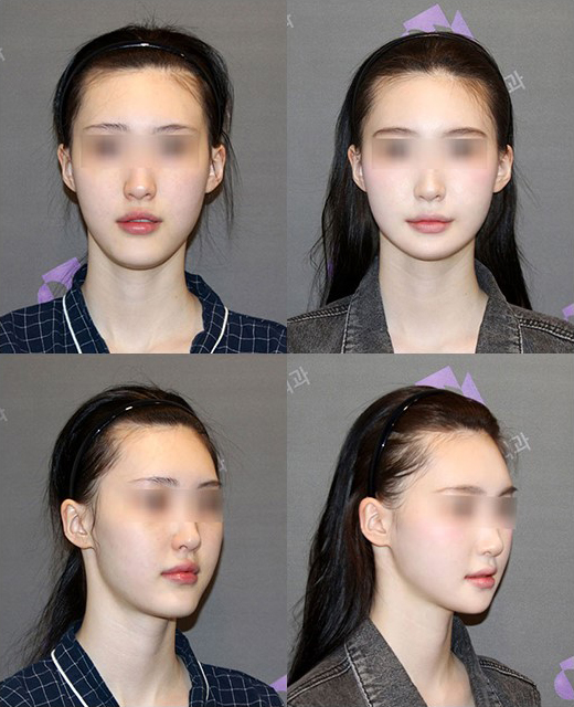 Will Summer Plastic Surgery, Especially Facial Contouring Surgery, Be Affected by the Season? image 4