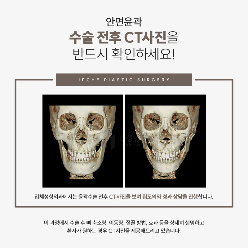 윤곽수술 후 감각은 언제 돌아올까요? 관련 이미지 3