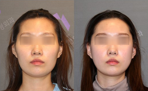 Cheekbone Reduction Surgery: A 2–3 mm Difference in the Side Cheekbones Makes a Big Change in the Face. image 3