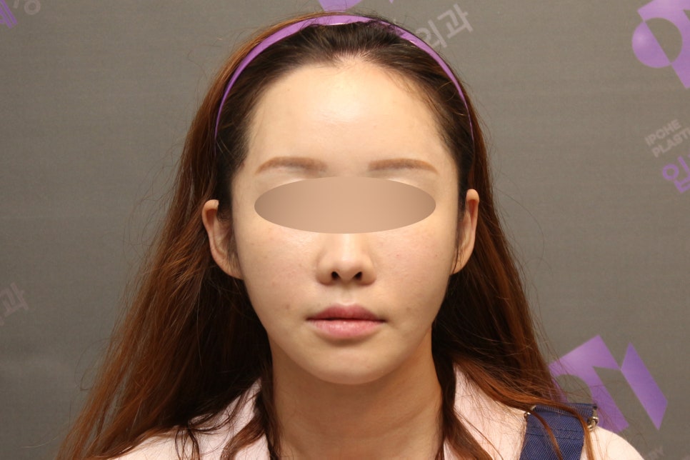 옆광대수술후기, 사례와 함께 알아보기 - 전문의가 직접알려드립니다. 관련 이미지 6