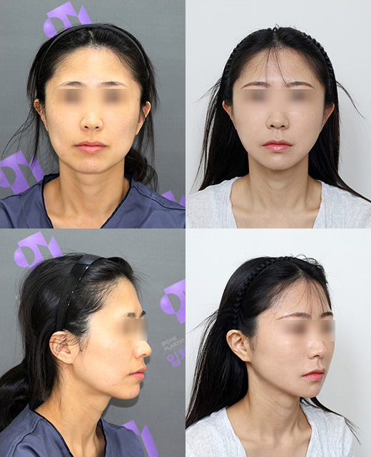 Facial Contouring A to Z: What Is Contouring Surgery? image 14