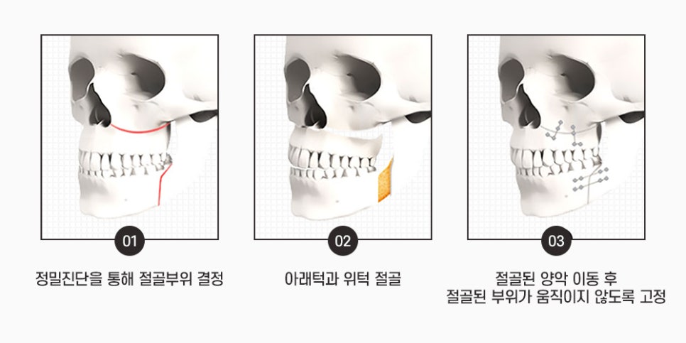 안면윤곽수술과 양악수술은 어떻게 다른가요? 관련 이미지 2