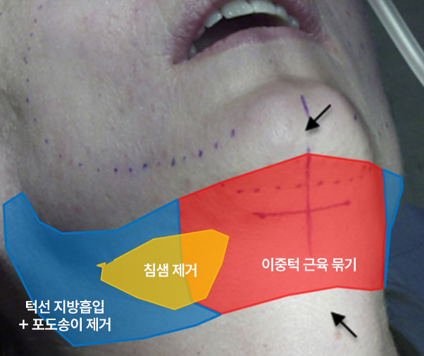이중턱 근육묶기의 최소 절개와 해부학적 구조 관련 이미지 4