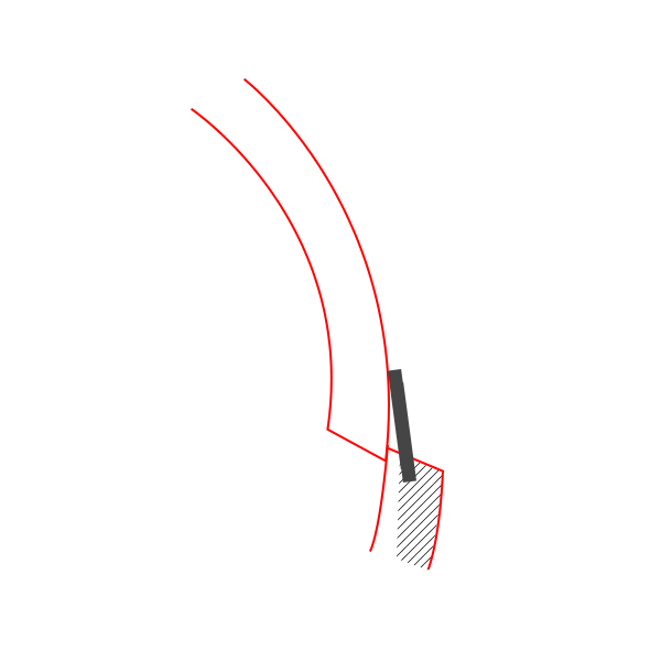 Back Cheekbone Shaving? Osteotomy? Do You Really Need It? image 9