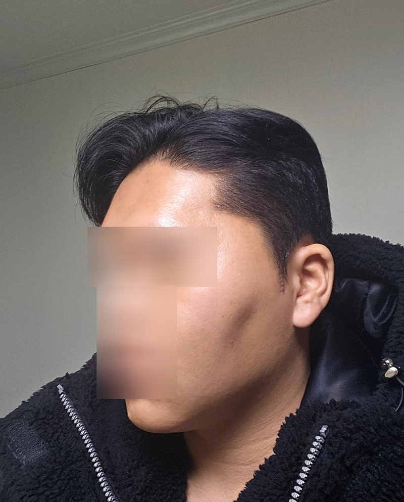 광대수술 후 나타날 수 있는 불편한 증상들은 어떤 것이 있을까요? 관련 이미지 4