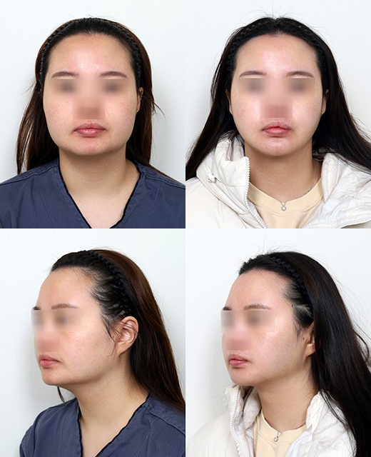사각턱 유형에 따라 수술 효과가 달라진다? 말린 턱과 뻗친 턱의 차이 관련 이미지 8