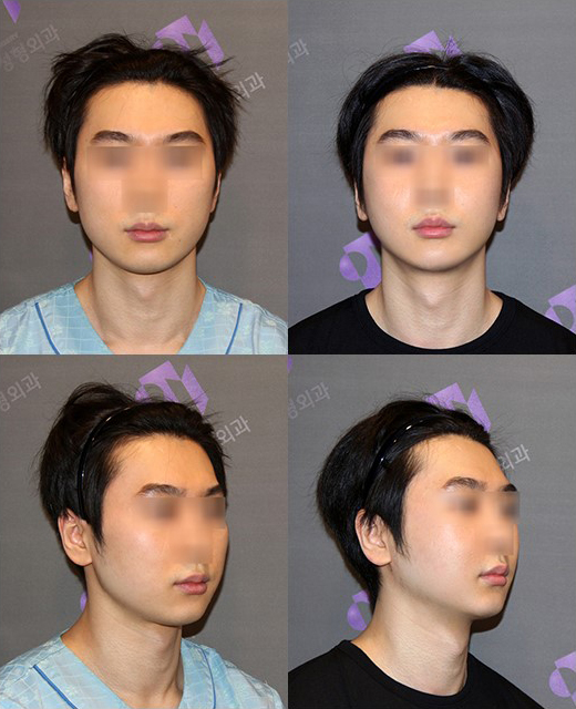 Is it good to combine facial contouring surgery with buccal fat removal? image 3