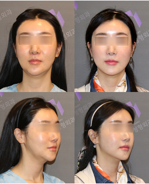 What Procedures Are Good to Have After Facial Contouring Surgery? image 5