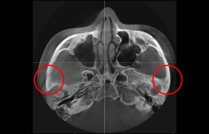 Will cheekbone reduction surgery also make the face smaller? : Learn about how to reduce prominent cheekbones with real surgical cases image 5