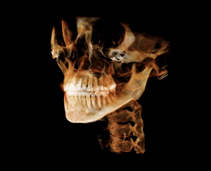 After Facial Contouring Surgery: Asymmetry, When Can Revision Surgery Be Performed? image 5