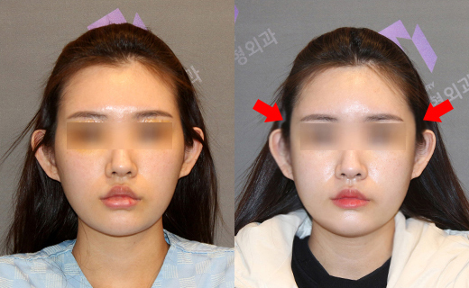 230도입체광대축소술이 일반 3D광대수술보다 더 좋은가요? 관련 이미지 5