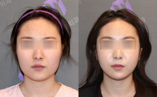 사각턱수술, 피질절골과 외측피질쉐이빙의 차이 관련 이미지 12