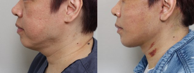 Amazing Changes Achieved with Contouring Facelift: A Facelift Technique That Even Addresses Asymmetry image 8