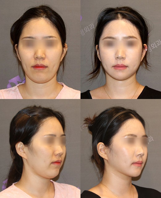 Cheekbone Reduction Surgery: A 2–3 mm Difference in the Side Cheekbones Makes a Big Change in the Face. image 7