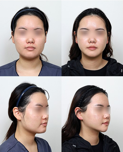 Does a Low Nerve Canal Make Square Jaw Surgery Difficult? Ways to Improve Frontal Results image 4