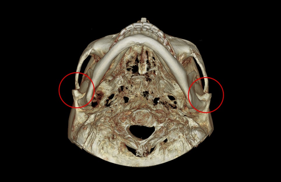 How Much Effect Does 230-Degree Zygoma Reduction Surgery Have? image 2