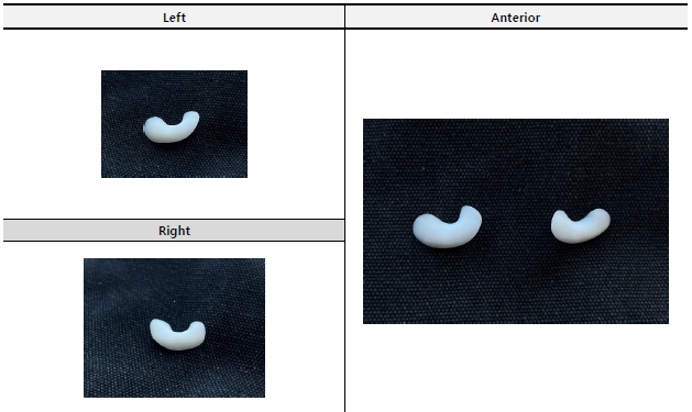 What Is the Best Way to Correct Deep-Set Eyes? image 6