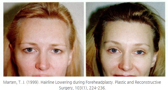 The Hidden History of Forehead Reduction Surgery &ndash; From Wong Fei-hung to Hair Transplantation and Modern Aesthetics image 5