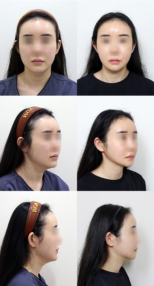 턱끝수술 후 대표적인 부작용 : 신경손상, 통증, 이중턱, 자갈턱 관련 이미지 4