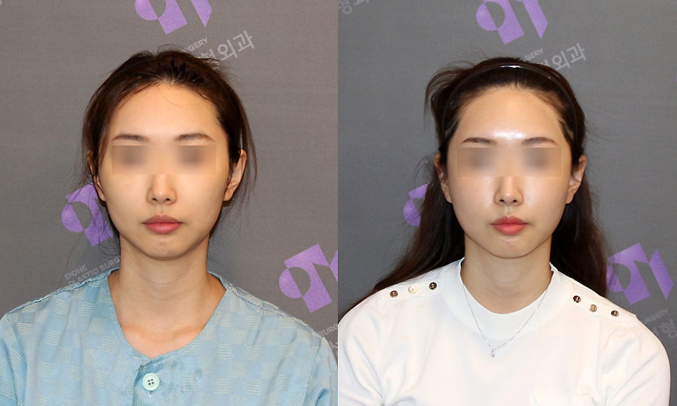 Consultation and Design Before Facial Contouring Surgery image 9