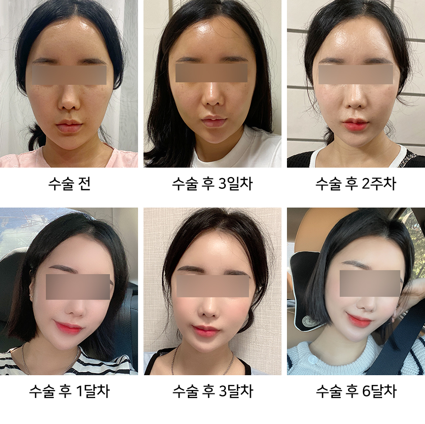 안면윤곽 붓기 빨리 빼는 법 총정리 - 성형외과 전문의가 알려드립니다 관련 이미지 2