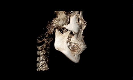 What Surgery Is Best for Correcting a Recessed Chin? The Limits of Chin Advancement Surgery and the Actual Results image 10