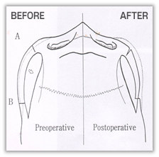 Zygoma Reduction Surgery: the Effectiveness and Selection Criteria of 230-Degree Zygoma vs. 3D Zygoma Surgery image 1