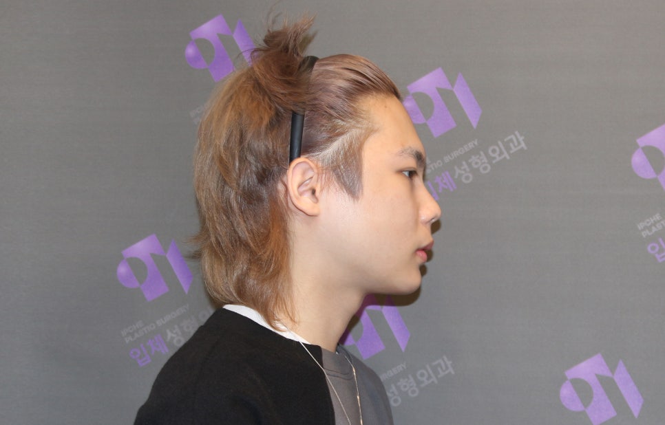 돌출입과 무턱은 윤곽수술로 교정이 가능할까요? 관련 이미지 6