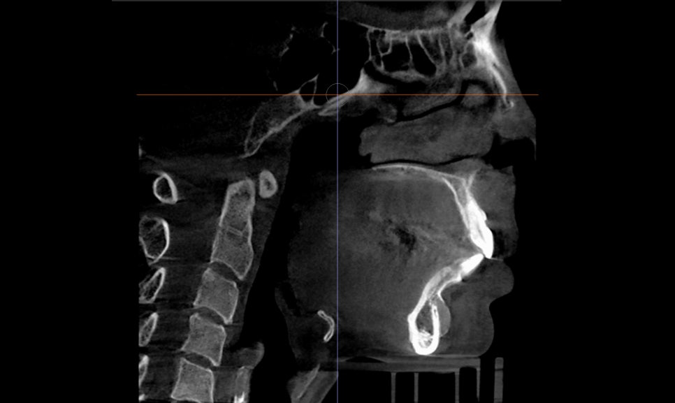 Does chin filler or an implant cause bone erosion? image 4