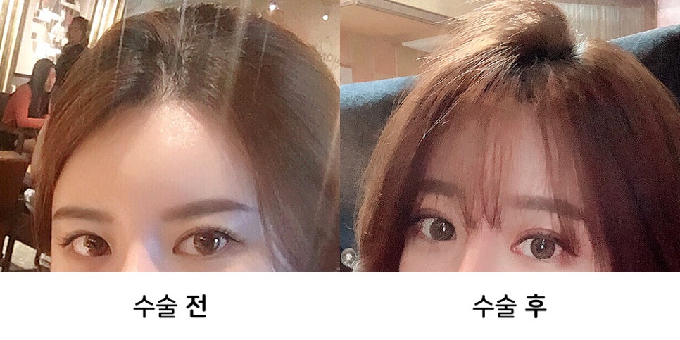 내시경이마거상술 붓기와 회복기간, 후기사진과 함께 알아보기 관련 이미지 4