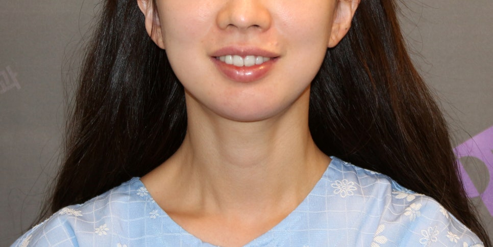 [Chin Surgery] Learning About Contouring Shave and T-Osteotomy with Real Patient Cases (2) image 9