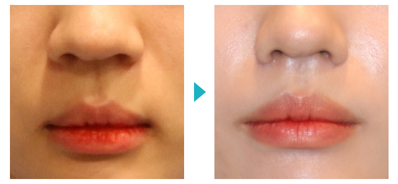 Surgery That Shortens the Midface Without Double Jaw Surgery: Philtrum Reduction Surgery image 3