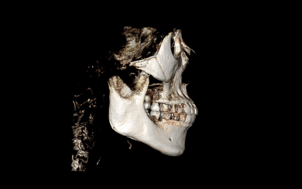 Consultation and Design Before Facial Contouring Surgery image 3