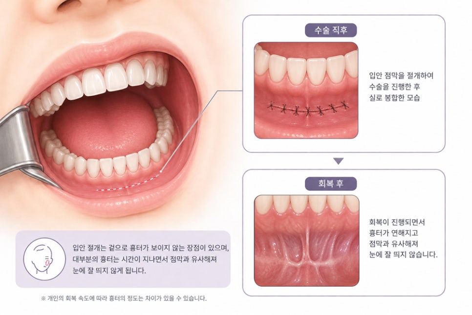윤곽수술 후 입안이 당기고 조이는 느낌, 흉살 때문일까요? 관련 이미지 1