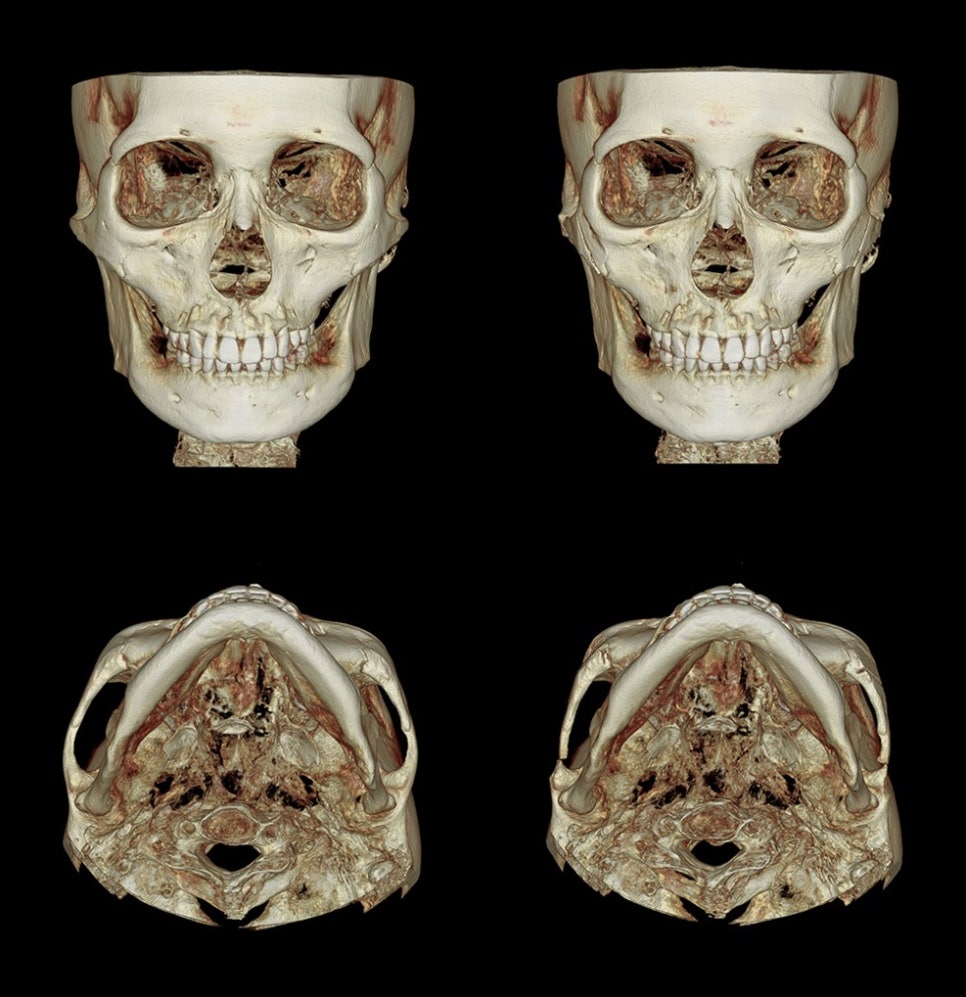 Zygoma Reduction Surgery: Effects and Differences Between 230-Degree and 3D Zygoma Reduction image 9