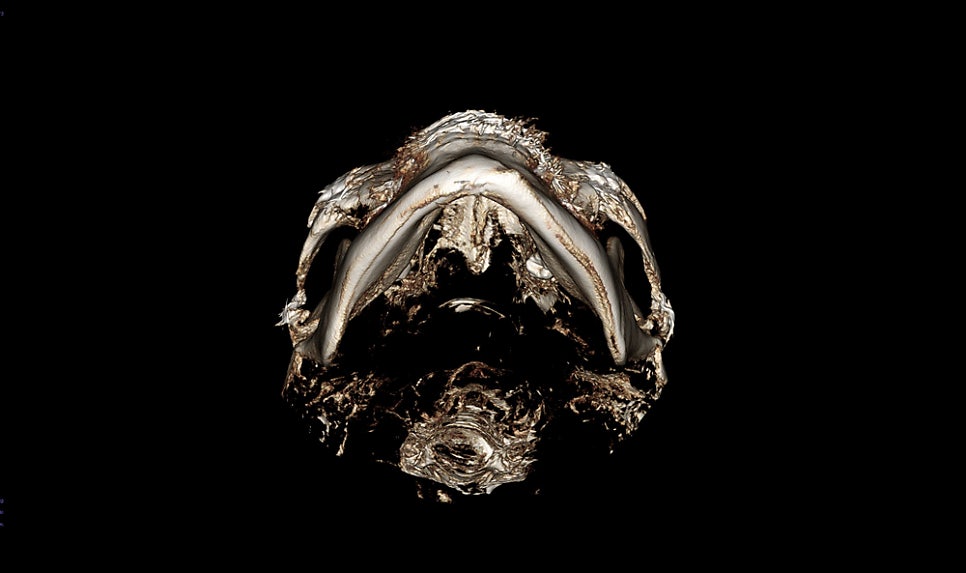 How Much Effect Does 230-Degree Three-Dimensional Zygomatic Reduction Have? image 10