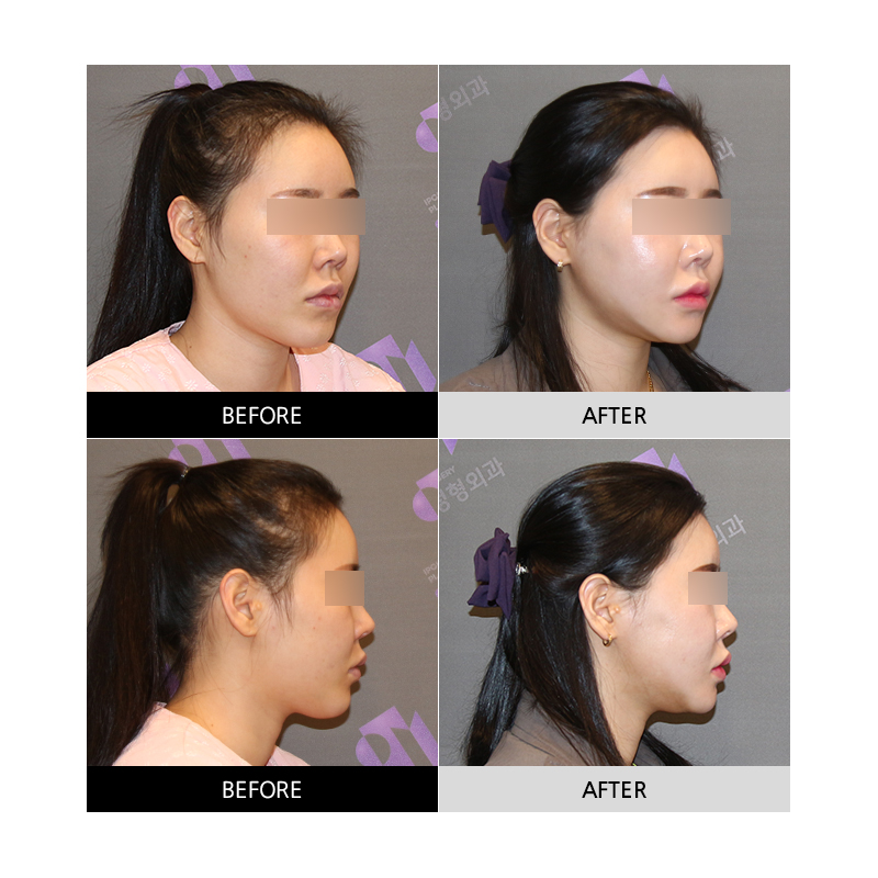 Side Effects After Facial Contouring (Square Jaw, Chin Tip) Surgery: Double Chin and Salivary Gland Enlargement image 3