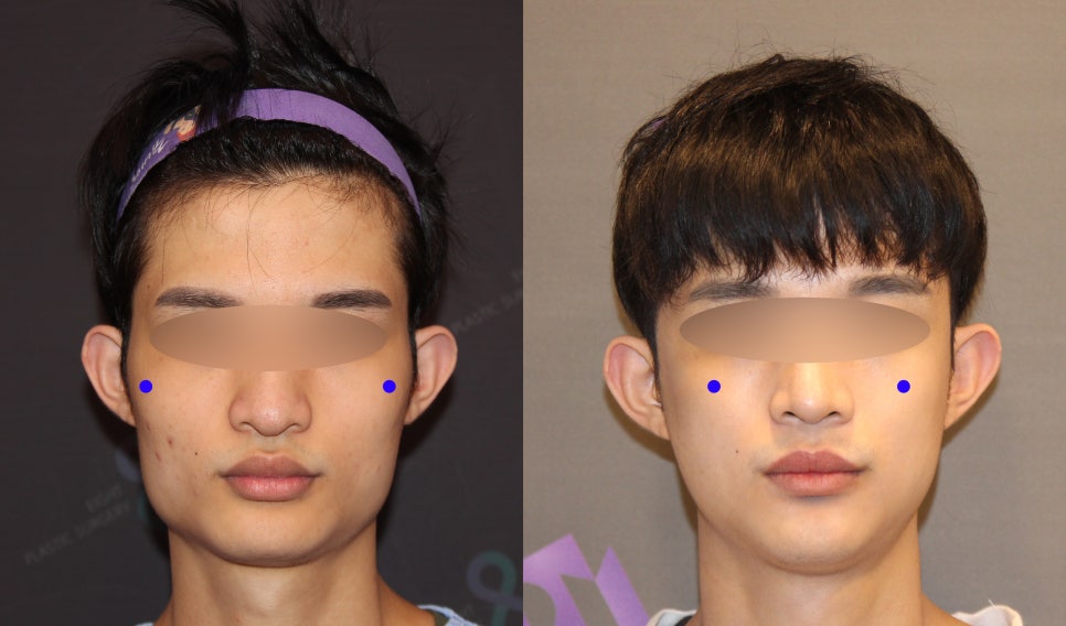 Male Facial Contouring (Square Jaw Surgery, Cheekbone Surgery, Chin Surgery) - Explained by a Specialist image 4