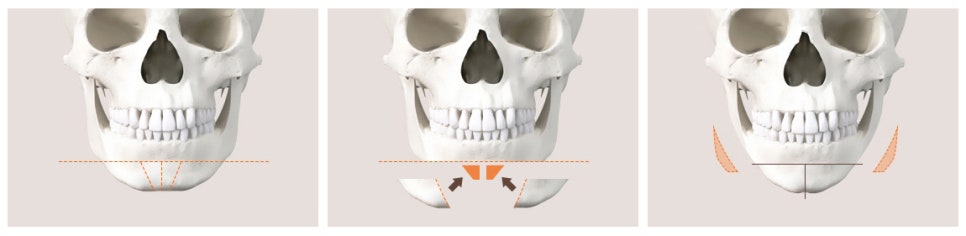 Why Are There So Many Different Chin Surgery Methods? Exploring Advancement, Setback, Reduction, and Lengthening image 8
