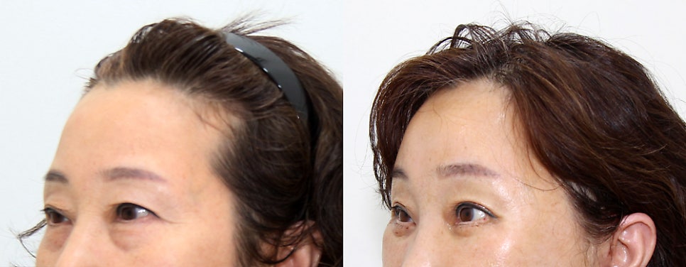 내시경 이마거상술 수술방법과 60대 환자의 놀라운 변화 관련 이미지 7