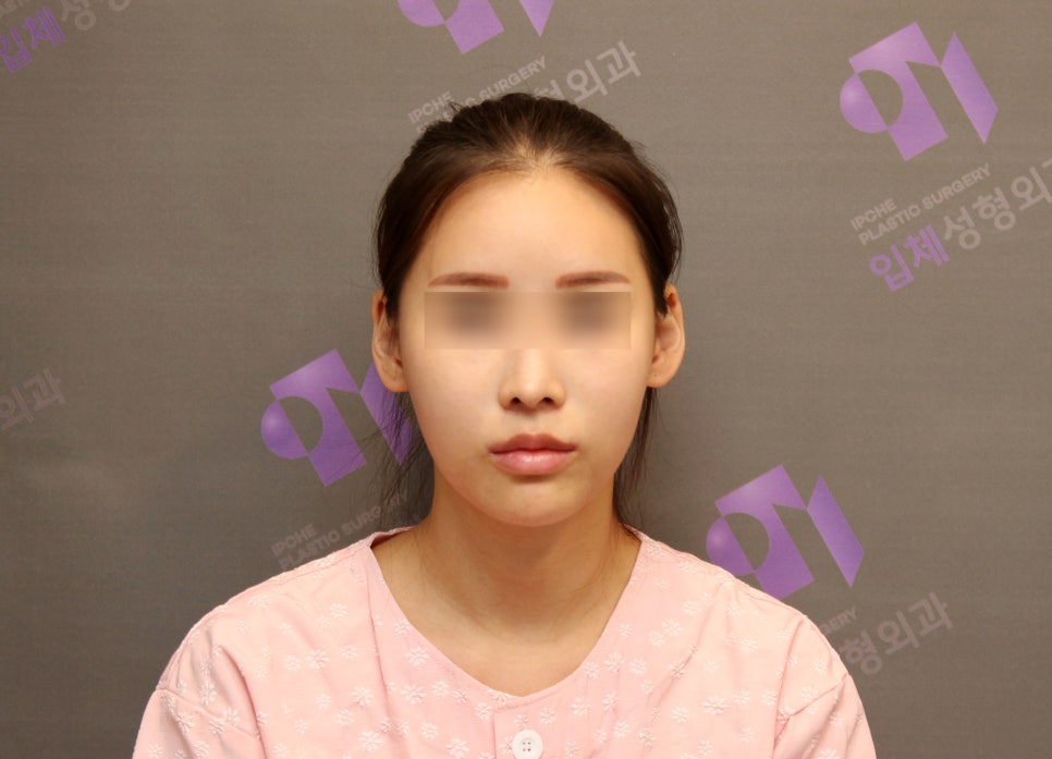 Review of Side Cheekbone Reduction Surgery image 1