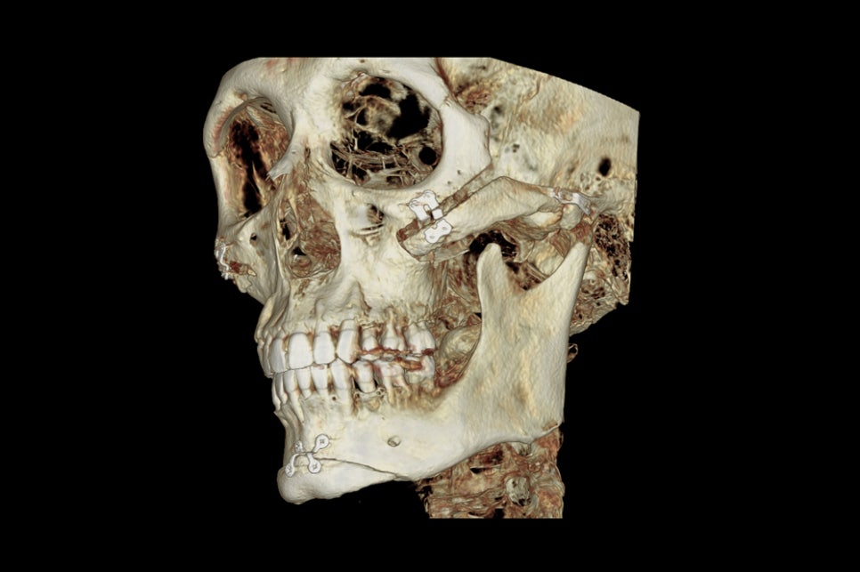 Are There Cases Where Pin Removal Is Difficult After Double Jaw or Contouring Surgery? image 6